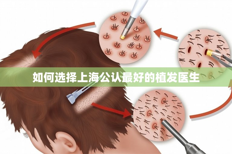 如何选择上海公认最好的植发医生