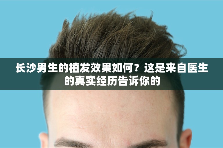 长沙男生的植发效果如何？这是来自医生的真实经历告诉你的