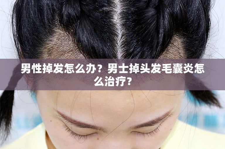 男性掉发怎么办？男士掉头发毛囊炎怎么治疗？