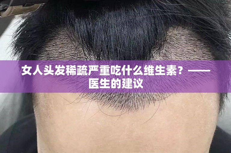 女人头发稀疏严重吃什么维生素？——医生的建议