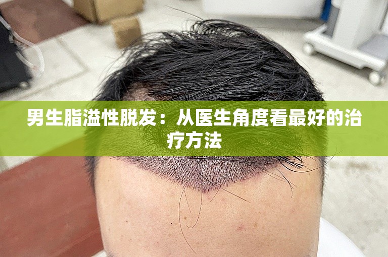 男生脂溢性脱发：从医生角度看最好的治疗方法