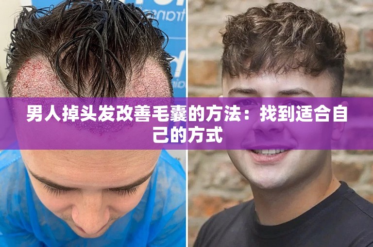 男人掉头发改善毛囊的方法：找到适合自己的方式