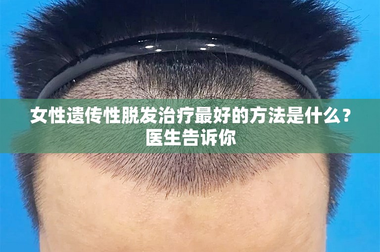 女性遗传性脱发治疗最好的方法是什么？医生告诉你