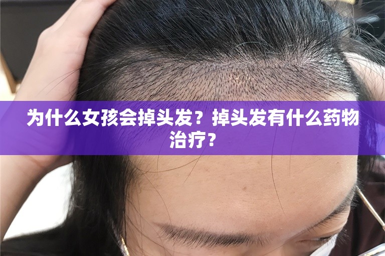 为什么女孩会掉头发？掉头发有什么药物治疗？