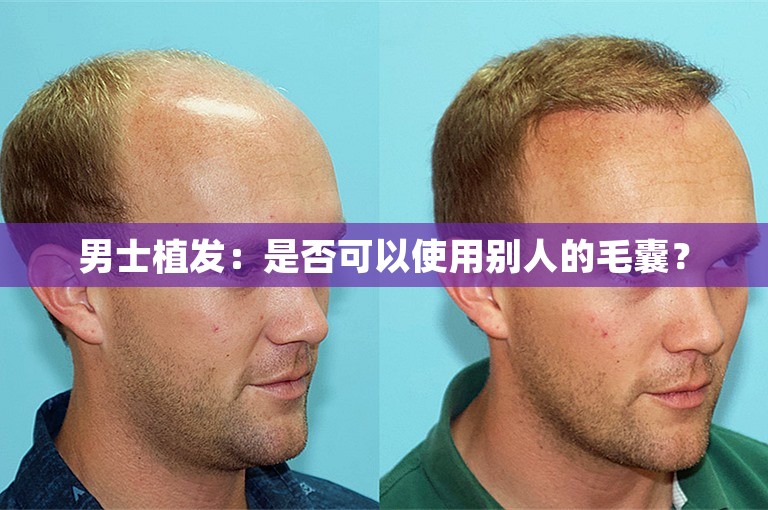 男士植发：是否可以使用别人的毛囊？