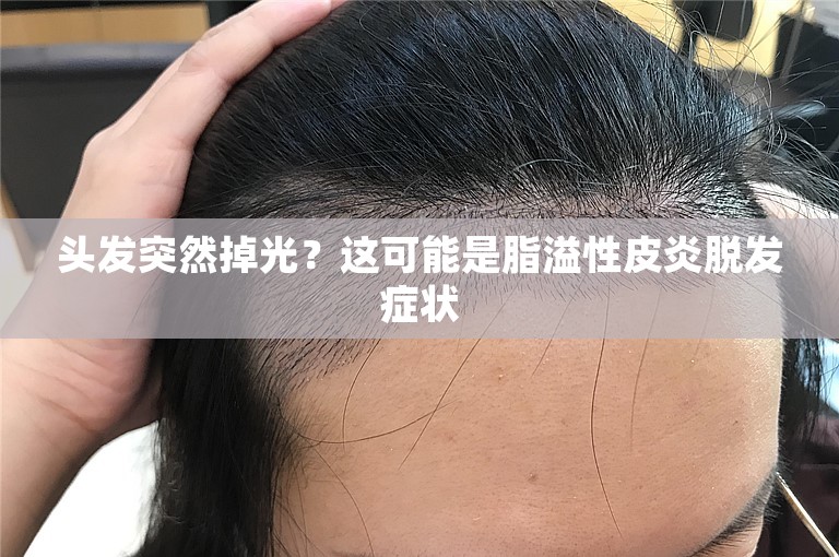 头发突然掉光？这可能是脂溢性皮炎脱发症状