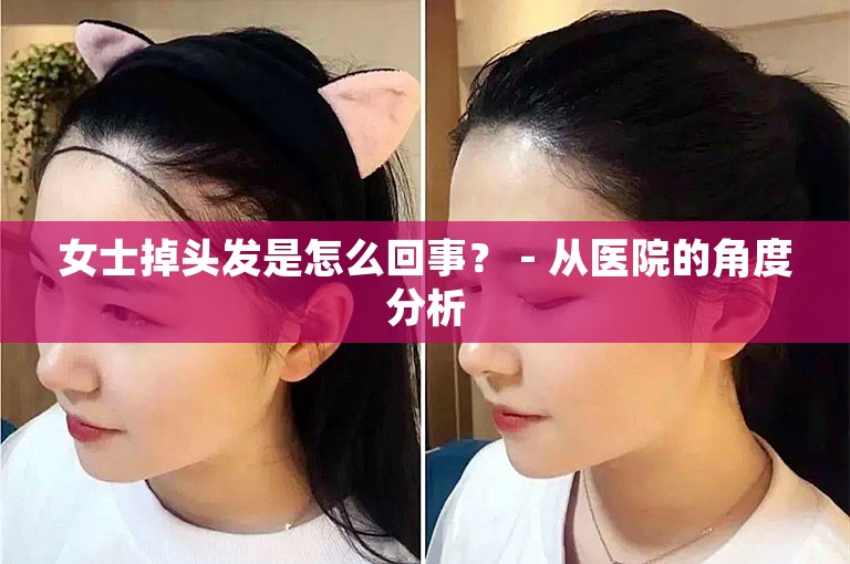 女士掉头发是怎么回事？ - 从医院的角度分析