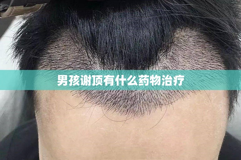 男孩谢顶有什么药物治疗