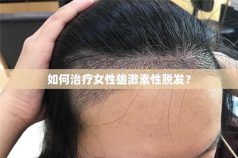 如何治疗女性雄激素性脱发？