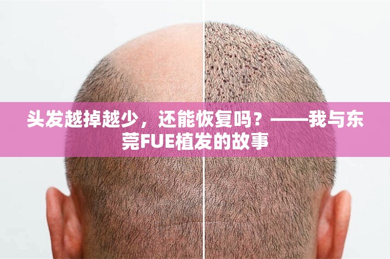 头发越掉越少，还能恢复吗？——我与东莞FUE植发的故事