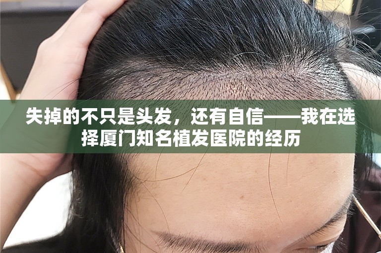 失掉的不只是头发，还有自信——我在选择厦门知名植发医院的经历