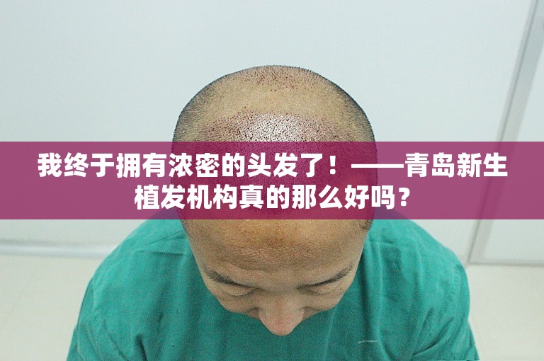 我终于拥有浓密的头发了！——青岛新生植发机构真的那么好吗？