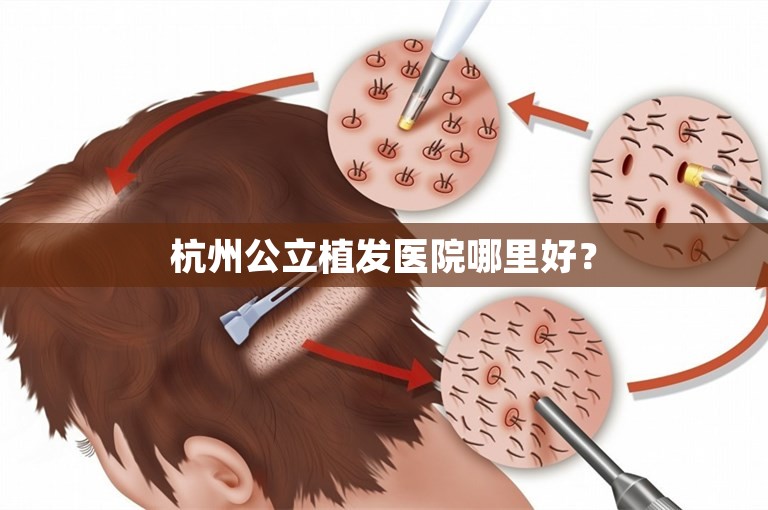 杭州公立植发医院哪里好？