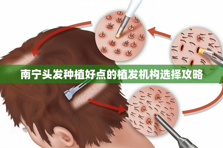 南宁头发种植好点的植发机构选择攻略