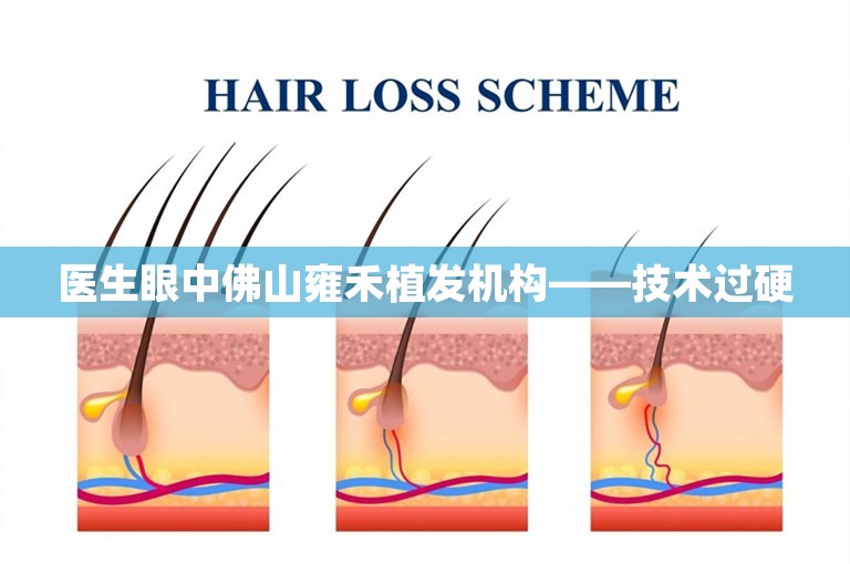 医生眼中佛山雍禾植发机构——技术过硬