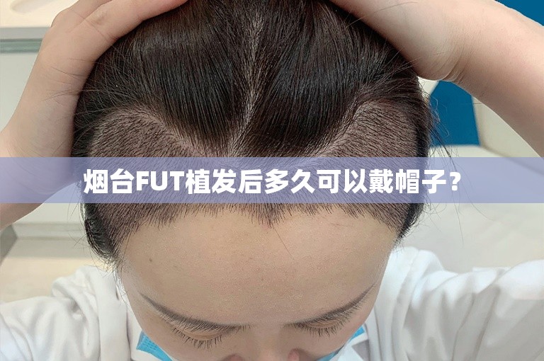 烟台FUT植发后多久可以戴帽子？