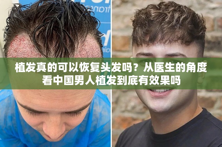 植发真的可以恢复头发吗？从医生的角度看中国男人植发到底有效果吗