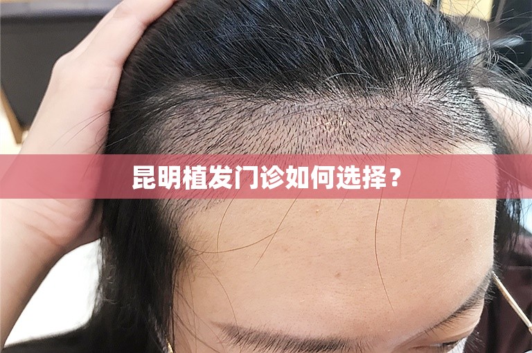 昆明植发门诊如何选择？