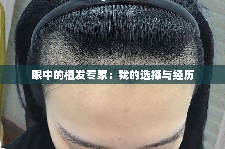 眼中的植发专家：我的选择与经历