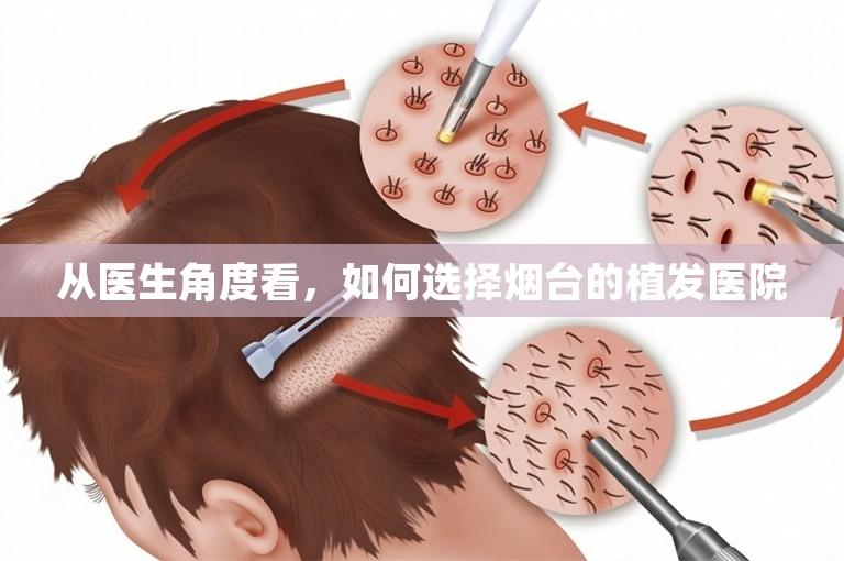 从医生角度看，如何选择烟台的植发医院