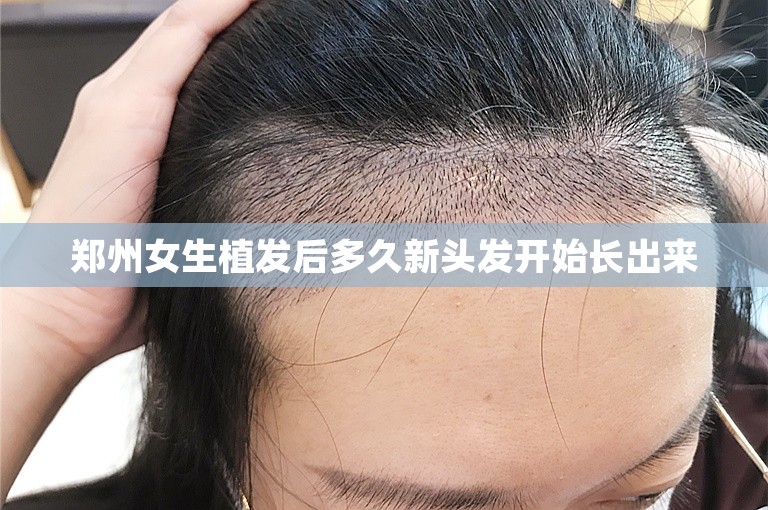 郑州女生植发后多久新头发开始长出来