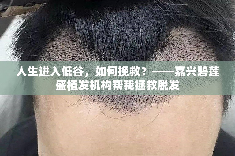 人生进入低谷，如何挽救？——嘉兴碧莲盛植发机构帮我拯救脱发