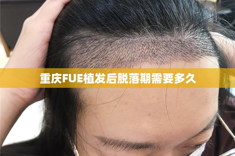 重庆FUE植发后脱落期需要多久