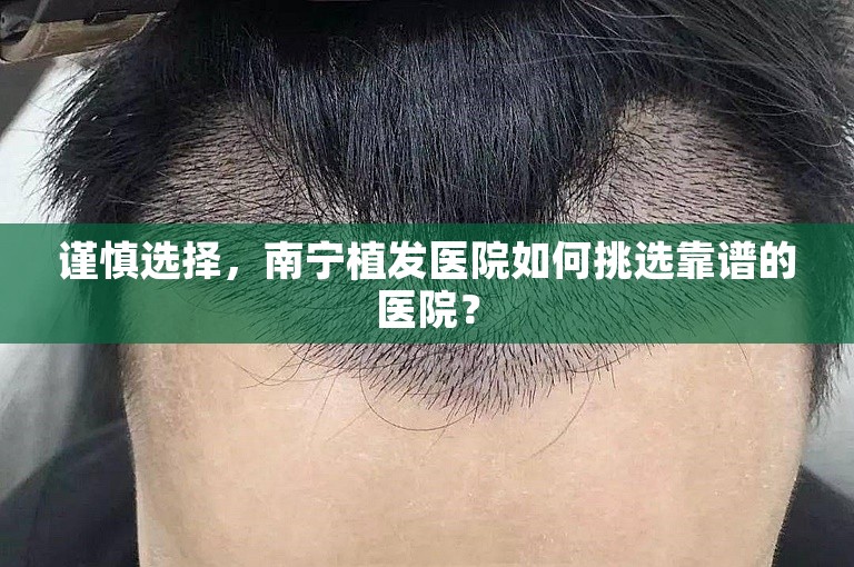 谨慎选择，南宁植发医院如何挑选靠谱的医院？