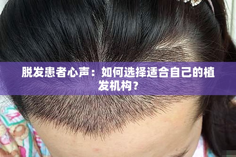 脱发患者心声：如何选择适合自己的植发机构？