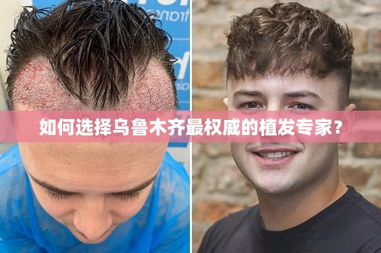 如何选择乌鲁木齐最权威的植发专家？