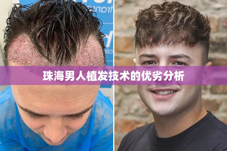 珠海男人植发技术的优劣分析