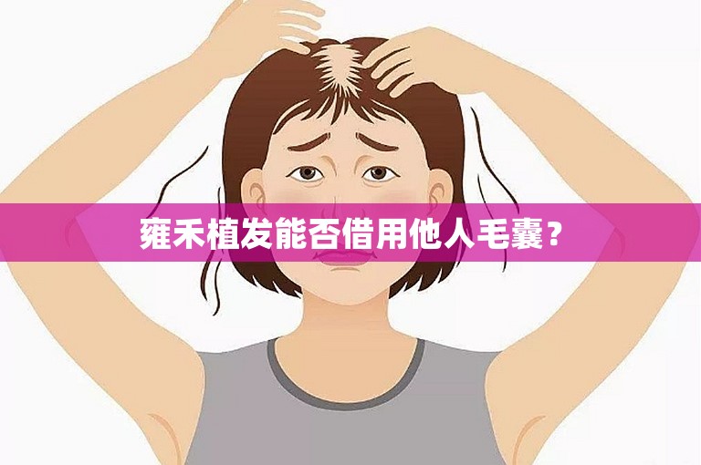 雍禾植发能否借用他人毛囊？