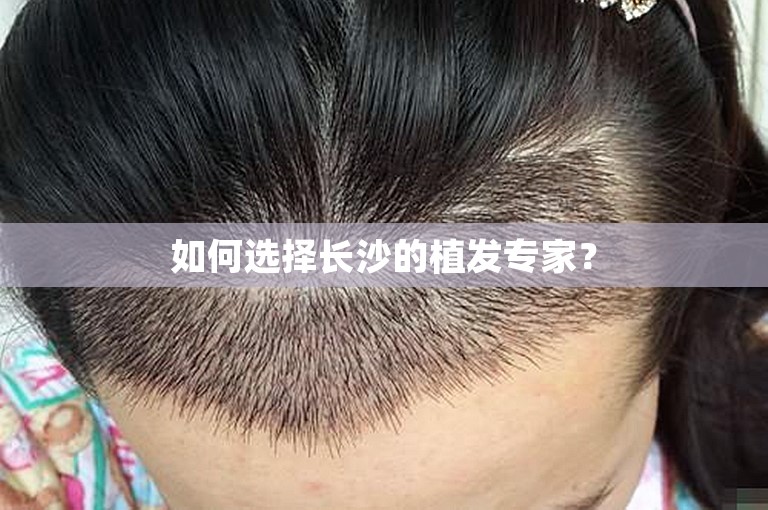 如何选择长沙的植发专家？