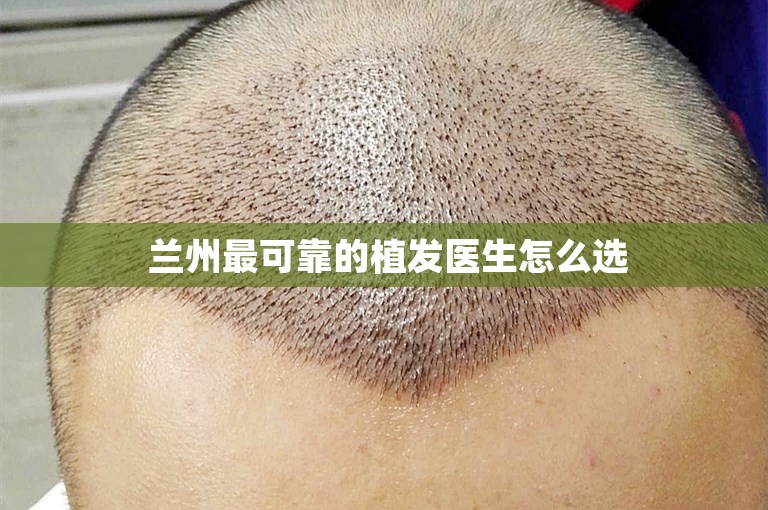  兰州最可靠的植发医生怎么选