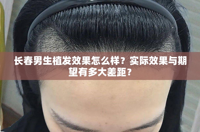 长春男生植发效果怎么样？实际效果与期望有多大差距？