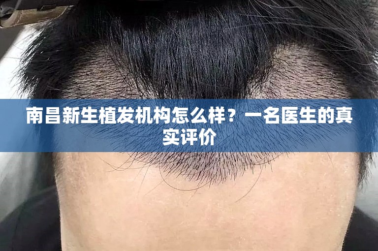 南昌新生植发机构怎么样？一名医生的真实评价