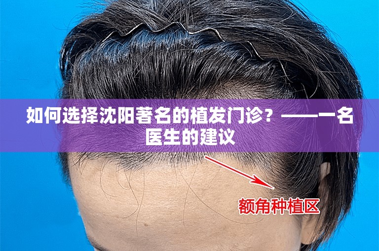 如何选择沈阳著名的植发门诊？——一名医生的建议