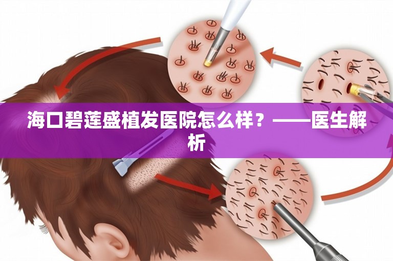 海口碧莲盛植发医院怎么样？——医生解析