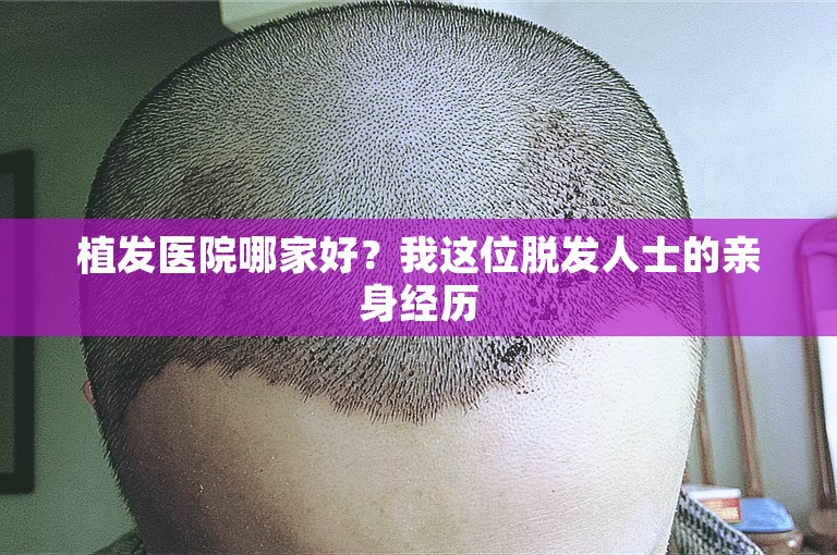 植发医院哪家好？我这位脱发人士的亲身经历