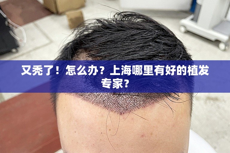 又秃了！怎么办？上海哪里有好的植发专家？