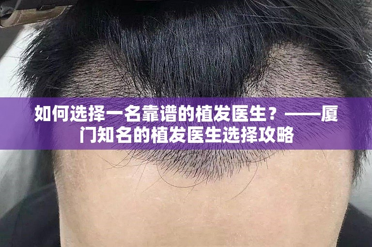 如何选择一名靠谱的植发医生？——厦门知名的植发医生选择攻略