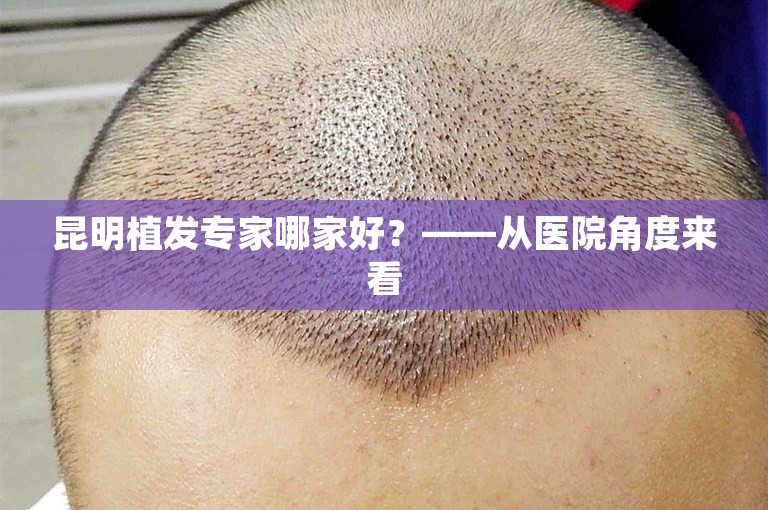 昆明植发专家哪家好？——从医院角度来看