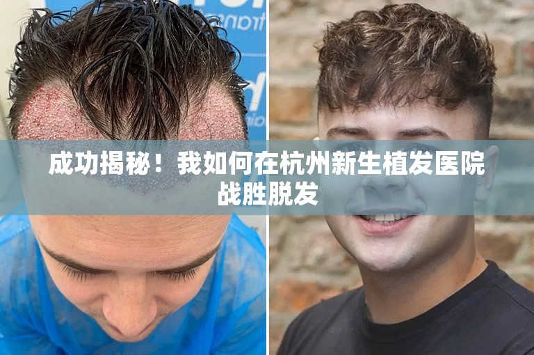 成功揭秘！我如何在杭州新生植发医院战胜脱发