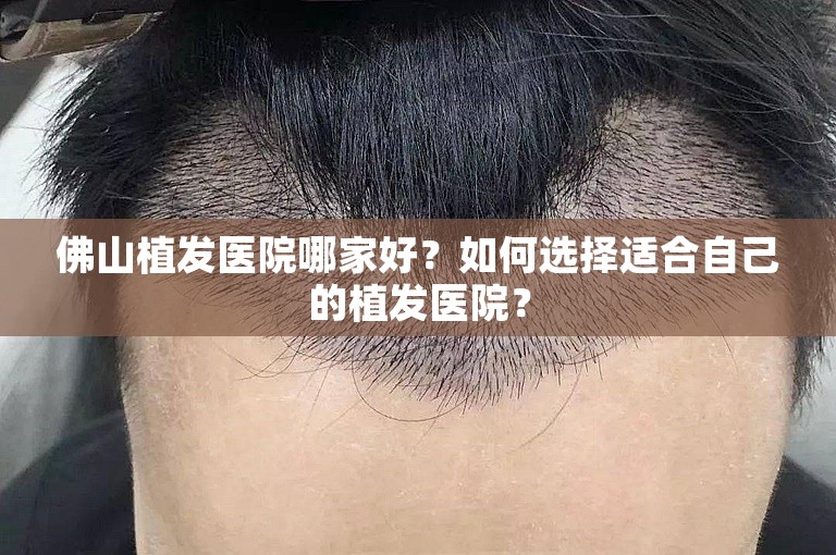 佛山植发医院哪家好？如何选择适合自己的植发医院？