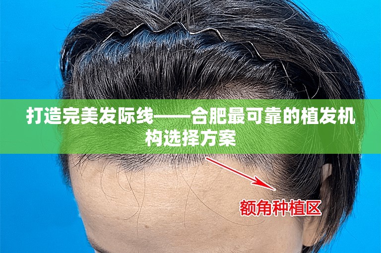 打造完美发际线——合肥最可靠的植发机构选择方案