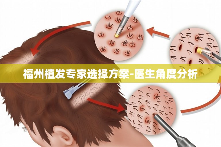 福州植发专家选择方案-医生角度分析