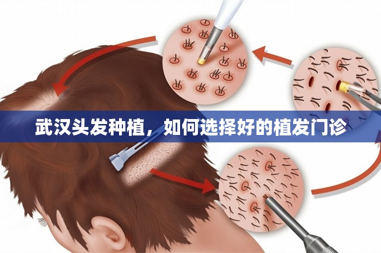 武汉头发种植，如何选择好的植发门诊