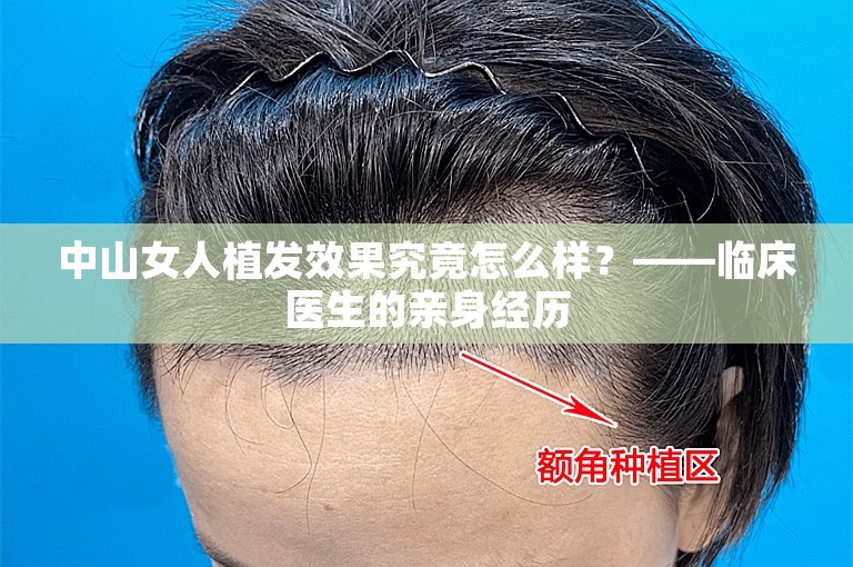 中山女人植发效果究竟怎么样？——临床医生的亲身经历