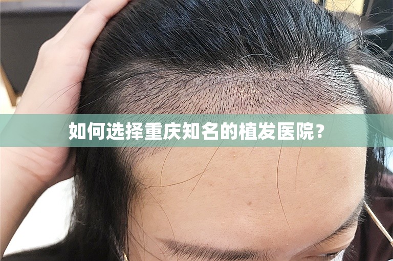 如何选择重庆知名的植发医院？