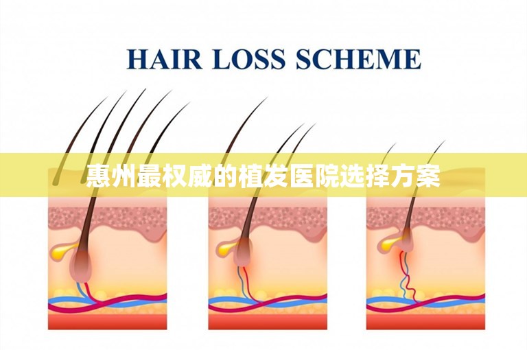 惠州最权威的植发医院选择方案